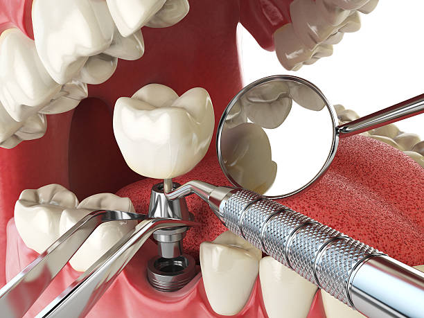 Best Emergency Dentist for Knocked-Out Tooth in Coquille, OR
